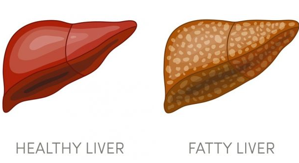 Chì Supplementi Eliminate Fatty Liver.png